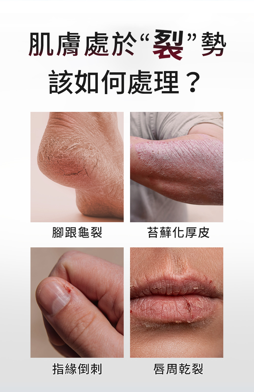 龜裂、苔癬化、嘴唇乾裂