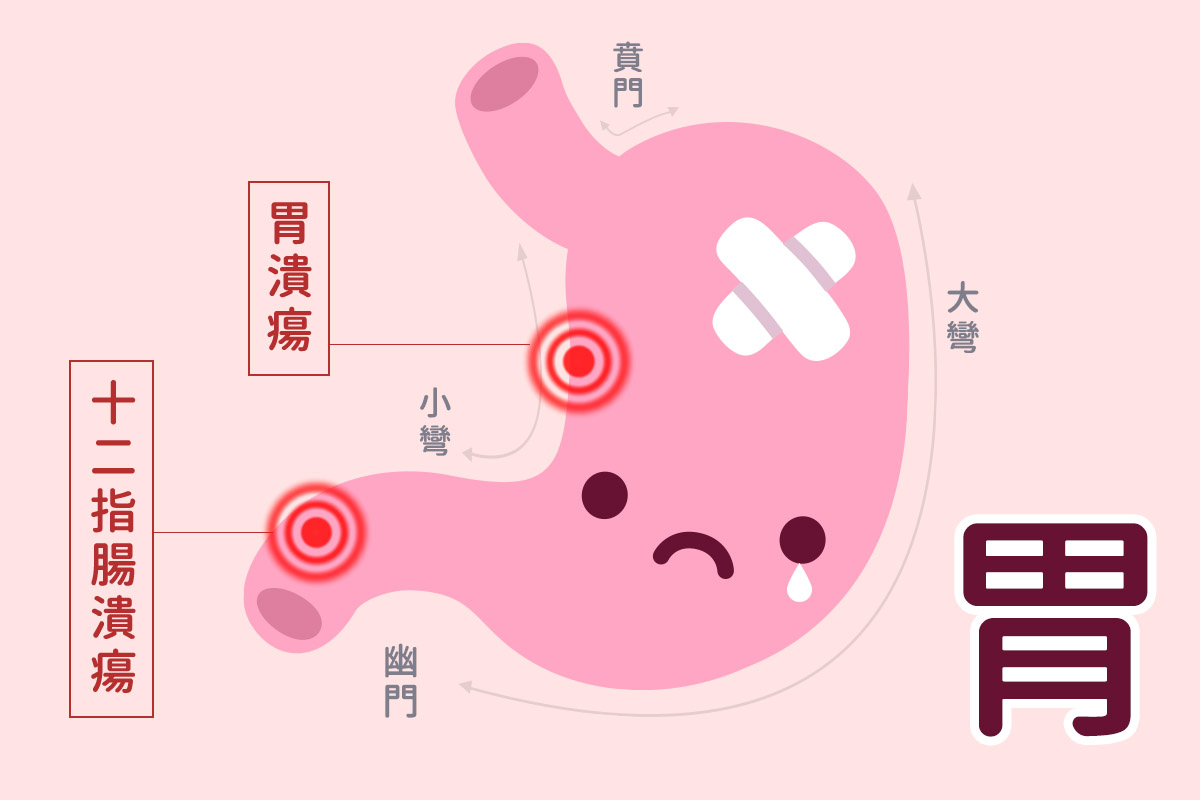 十二指腸潰瘍